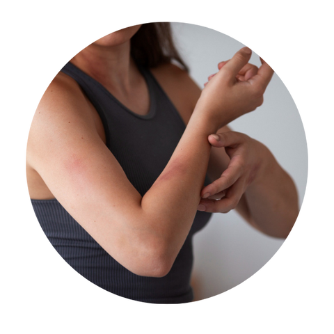 Dermatites e Psoríase